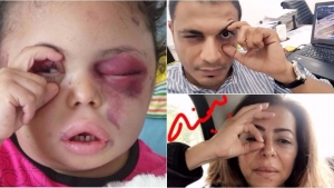 02.09.2017 - Une fillette yéménite incarne la violence saoudienne